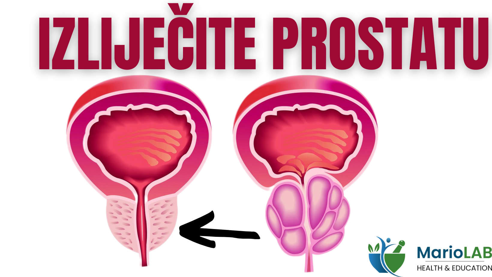 Kann Man Die Prostata Entfernen